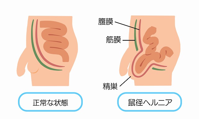 鼠径ヘルニア（脱腸）